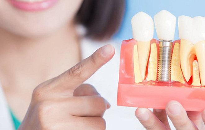﻿АТОшники Днепропетровщины могут бесплатно сделать имплантацию зубов